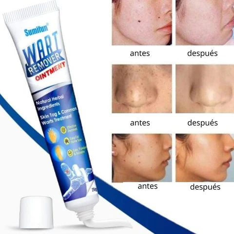 REMOVEDOR DE VERRUGAS - "WART REMOVER"